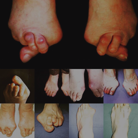 静岡 フルオーダーメイドシューズ 靴 友樹 外反母趾 インソール