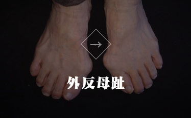 静岡 フルオーダーメイドシューズ 靴 友樹 外反母趾 インソール