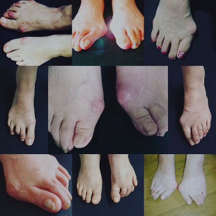 静岡 フルオーダーメイドシューズ 靴 友樹 外反母趾 インソール