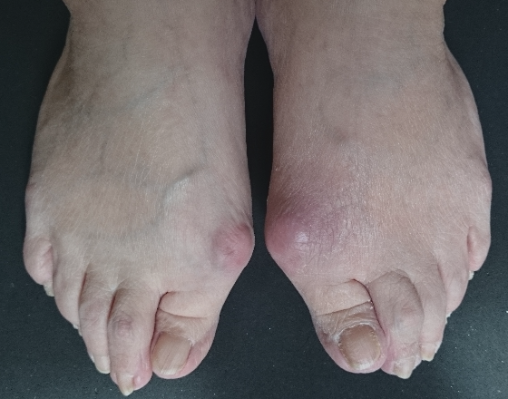 静岡 フルオーダーメイドシューズ 靴 友樹 外反母趾 インソール