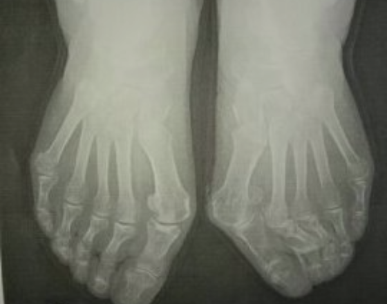 静岡 フルオーダーメイドシューズ 靴 友樹 外反母趾 インソール