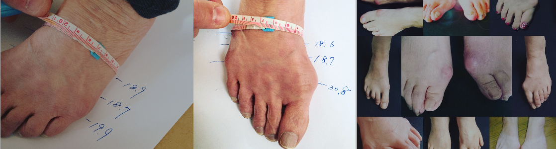 静岡 フルオーダーメイドシューズ 靴 友樹 外反母趾 インソール