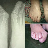 オーダー靴,オーダーメイドシューズ,オーダーメイド靴,外反母趾