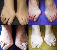 オーダー靴,オーダーメイドシューズ,オーダーメイド靴,外反母趾