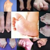 オーダー靴,オーダーメイドシューズ,オーダーメイド靴,外反母趾