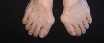 外反母趾,オーダー靴,オーダーメイドシューズ