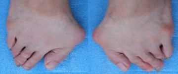 外反母趾,リウマチ,オーダー靴