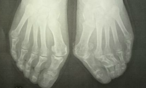 オーダー靴,オーダーメイドシューズ,外反母趾