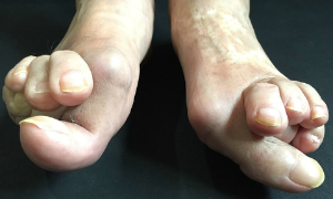 オーダー靴,オーダーメイドシューズ,外反母趾