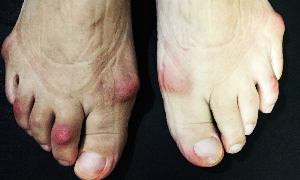 オーダー靴,オーダーメイドシューズ,外反母趾