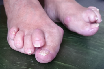 外反母趾,オーダー靴,オーダーメイドシューズ