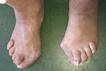 外反母趾,リウマチ,オーダー靴