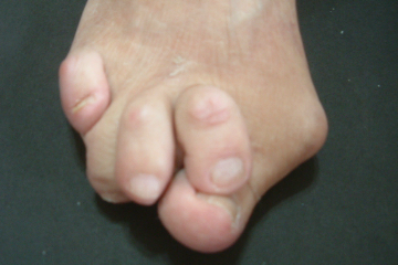 外反母趾,オーダー靴,オーダーメイドシューズ