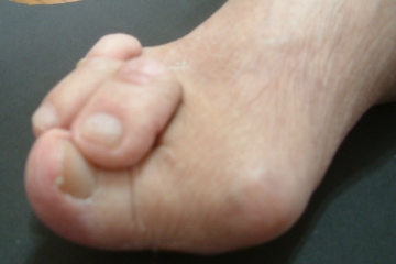 外反母趾,リウマチ,オーダー靴
