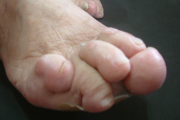 外反母趾,オーダー靴,オーダーメイドシューズ