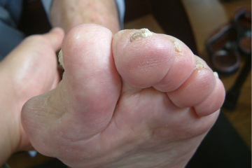 外反母趾,リウマチ,オーダー靴