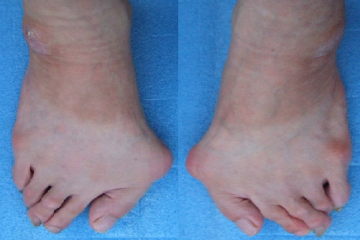 外反母趾,オーダー靴,オーダーメイドシューズ