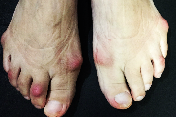 外反母趾,リウマチ,オーダー靴