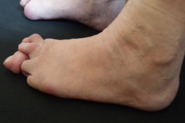 外反母趾,オーダー靴,オーダーメイドシューズ