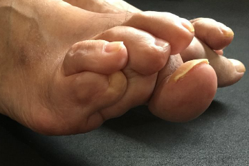 外反母趾,オーダー靴,オーダーメイドシューズ