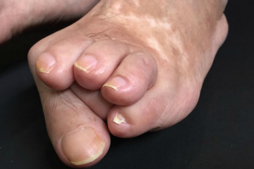 外反母趾,リウマチ,オーダー靴