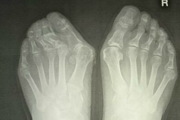 外反母趾,オーダー靴,オーダーメイドシューズ