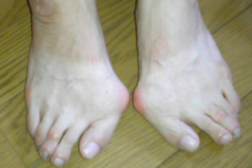 外反母趾,リウマチ,オーダー靴