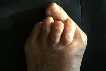 外反母趾,オーダー靴,オーダーメイドシューズ