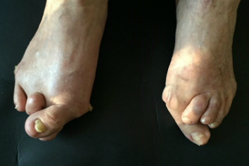 外反母趾,リウマチ,オーダー靴